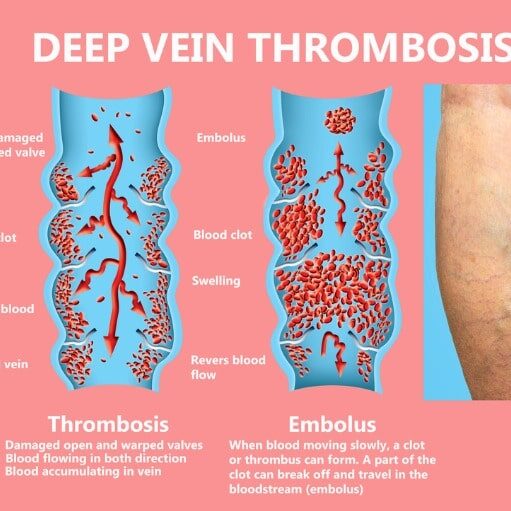 deep vein thrombosis or blood clots embolus picture id1128735290 circle