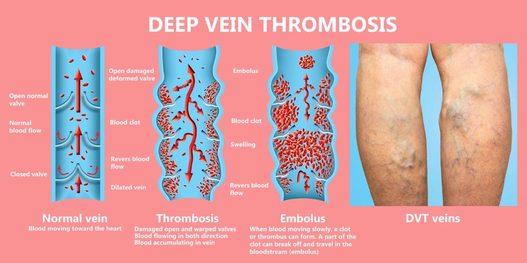 illustration of normal vein compared to one with thrombosis blood clot vs one with embolus blood clot next to photograph of leg with dvt veins