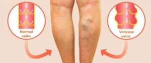 back of pair of legs, left with no varicose veins, right with bulging varicose veins