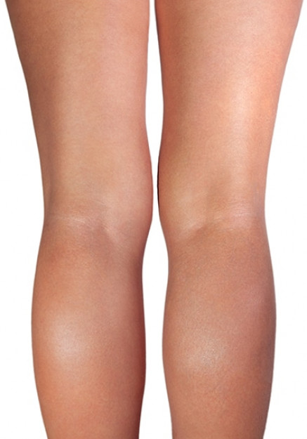 Healthy Leg and The Affected Varicose Veins